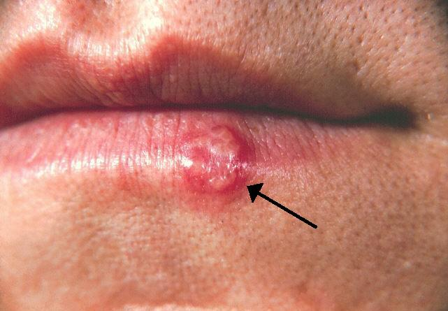 A man with a cold sore or herpes on his mouth