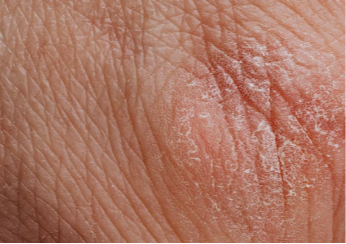 Close-up of dry patch on the skin.