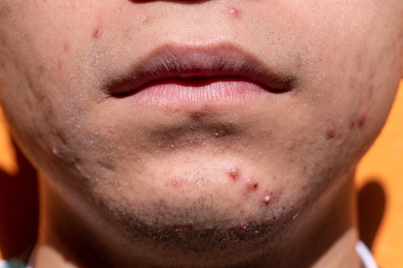 A closeup of a person with acne issues