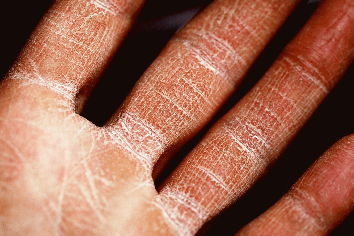 Close-up photo of a hand with dry, cracked skin on the palm and fingers