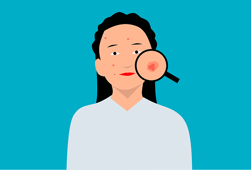 Illustration of woman with acne