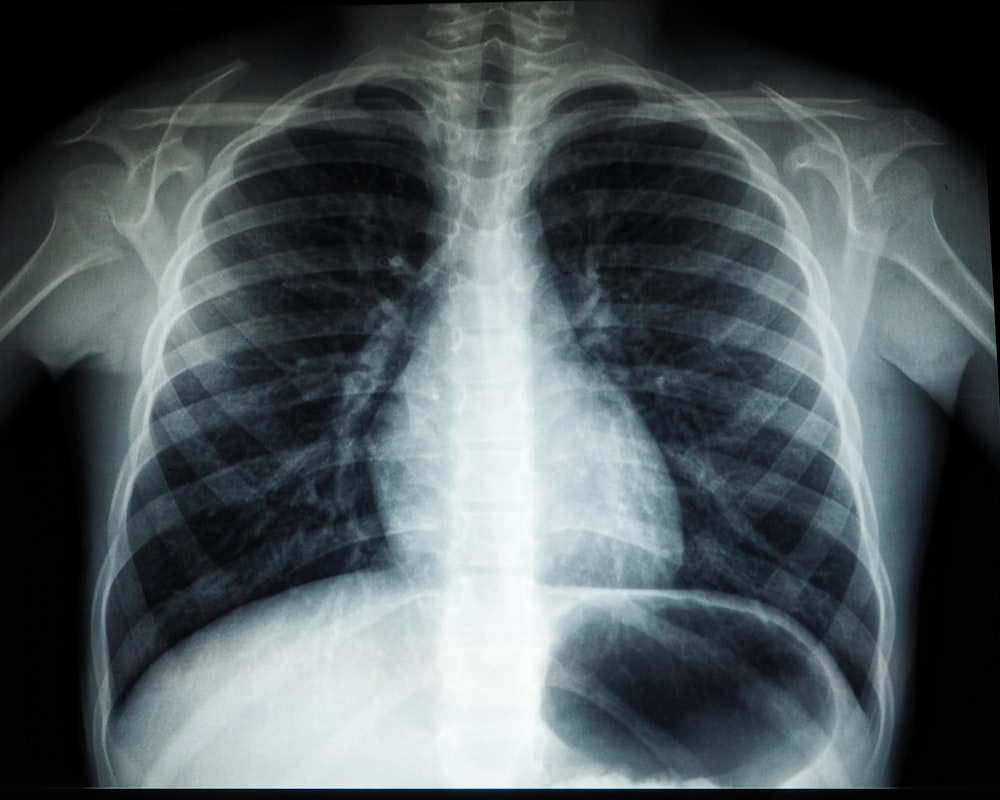 An image of a lung X-ray