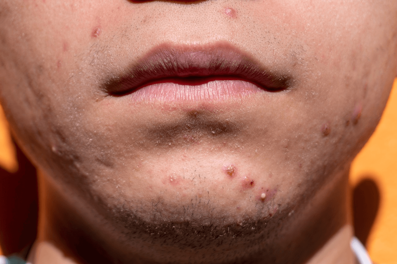 A close-up of a man's chin with acne