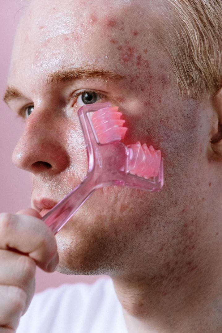 Man with severe acne using skincare tool