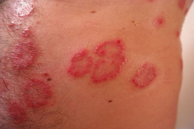 skin with red patches of psoriasis