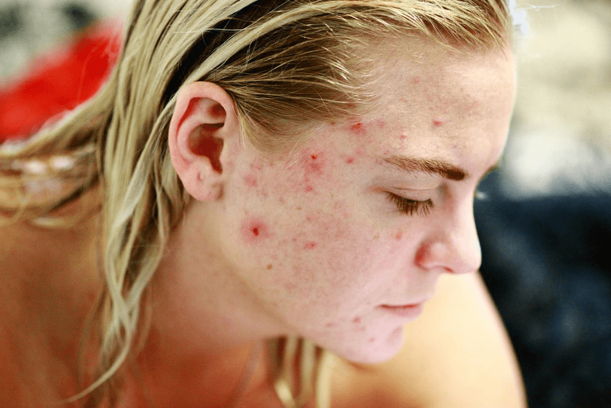 A close-up of a woman's face with acne 