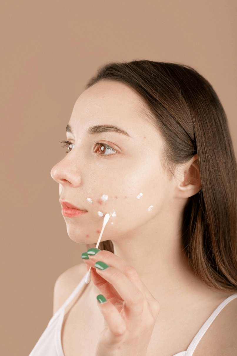 A woman applying facial cream for acne treatment