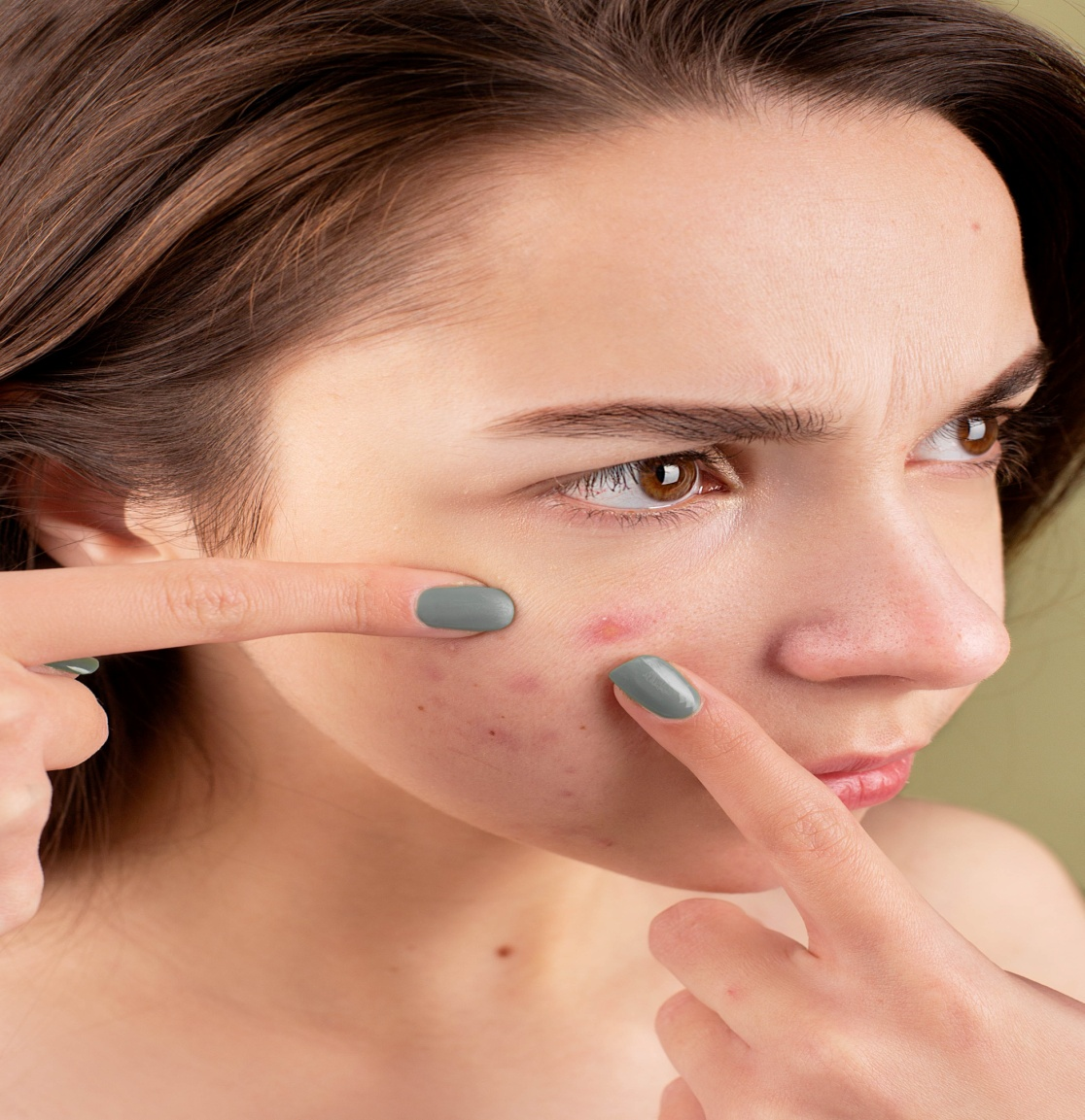 A woman squeezing her acne with her fingers.