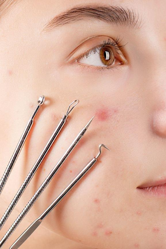 Woman with acne holding dermatology tools