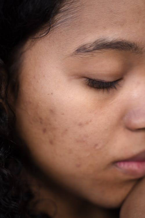 A closeup image of a woman with acne on her face