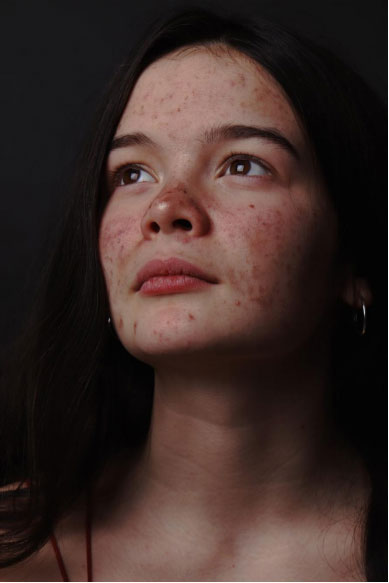 a woman with acne