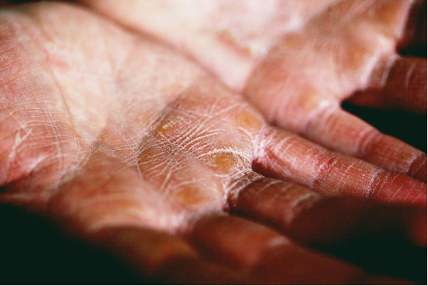 An eczema patient with extremely dry hands