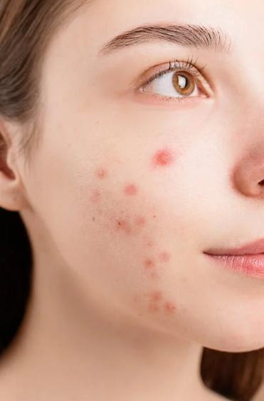 a girl with acne on her face