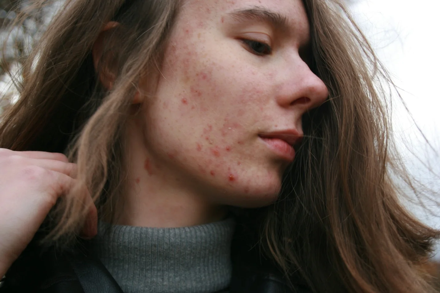 a person with facial acne