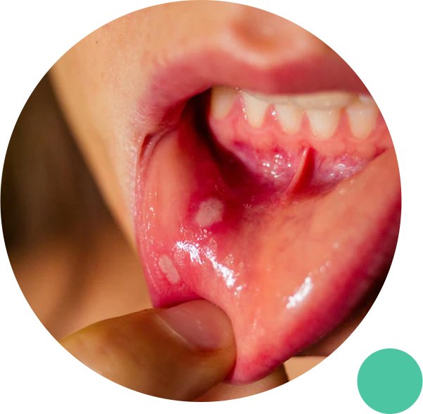 White Spots On Tonsils Thrush