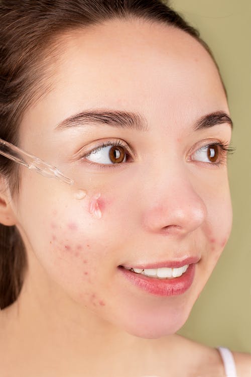 a woman with acne