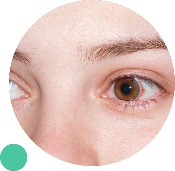 Virtual Doctor For Pink Eye, Pink Eye Symptoms