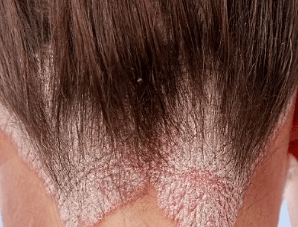 Closeup of a scalp psoriasis patch