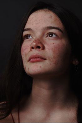 a girl with damaged skin due to exposure to harmful UV rays