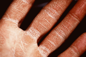 Skin Health: Managing Eczema and Psoriasis