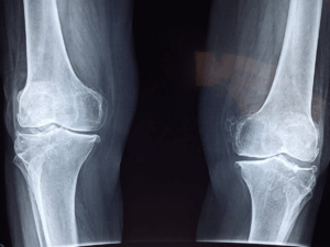 Understanding Osteoporosis: Prevention and Treatment Options
