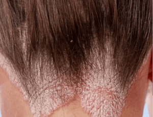 Caring for Psoriasis: Symptoms, Triggers, and Treatment Approaches