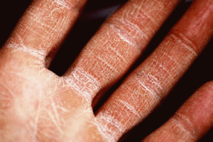 6 Things You Should Do To Keep Your Eczema From Flaring Up