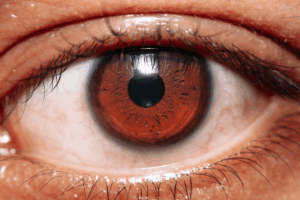 Pink Eye Unmasked: Causes, Contagion, and Care from the Comfort of Home