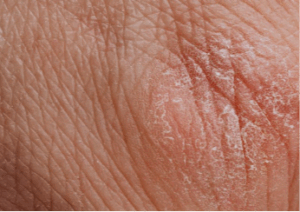 Most Common Skin Infections and Their Treatments