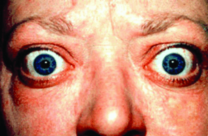 Hypothyroidism And Hyperthyroidism For Beginners