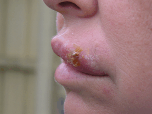 Herpes Simplex: Your FAQs Answered