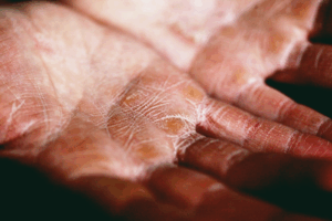 Why Do Psoriasis And Eczema Flare Up During The Winter!