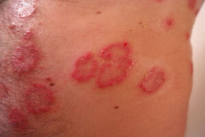 Types of Psoriasis Disorder and Their Causes