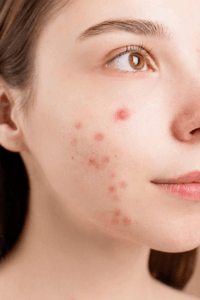 Everything You Need To Know About Acne