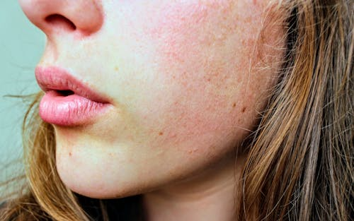 Close view of a woman’s face showing dry, red, and patchy skin.