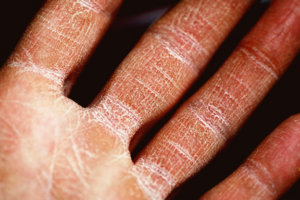 Eczema Flares in Winter: Spot Symptoms Early and Stop the Itch–Scratch Spiral