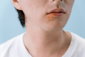 Cold Sores in Winter: Why They Flare and How to Calm Them Faster