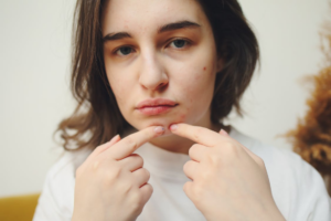 Jawline Breakouts in Warmer Weather