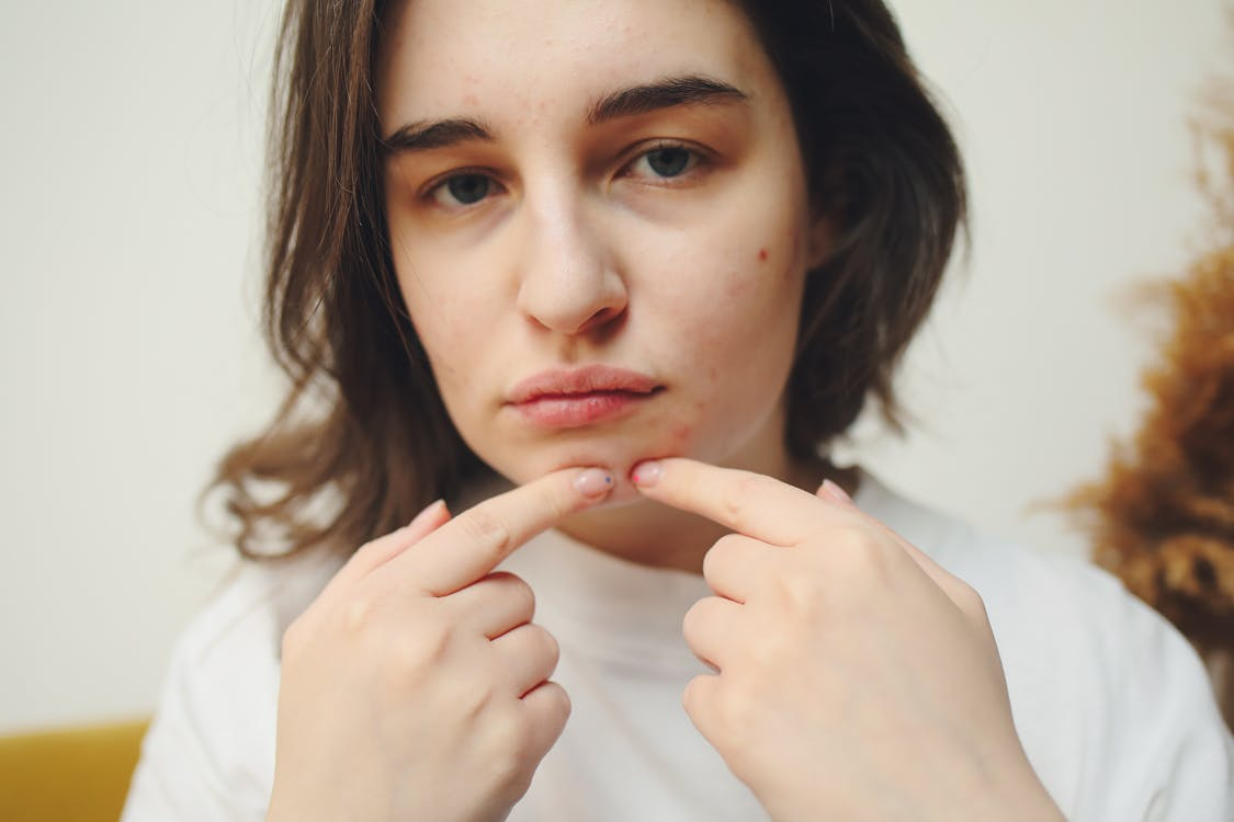 Close-up of a young woman examining jawline acne in spring