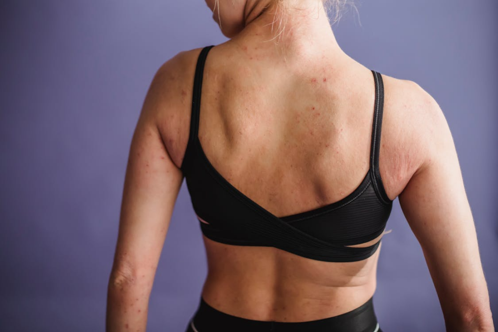 A person displaying their skin rash very proudly. 
