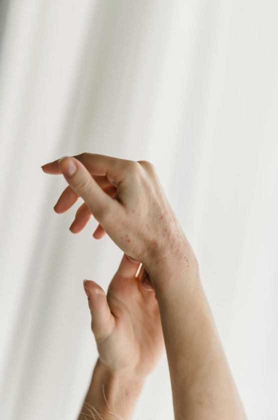 This photo shows a woman's hands with red rashes.
